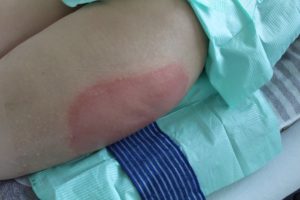 Kryolipolyse an den Oberschenkeln bei Ice Aesthetic