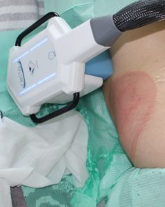 Kryolipolyse an den Hüften bei Ice Aesthetic