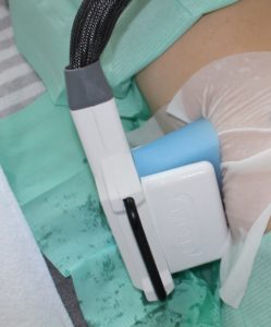 Kryolipolyse an den Hüften bei Ice Aesthetic