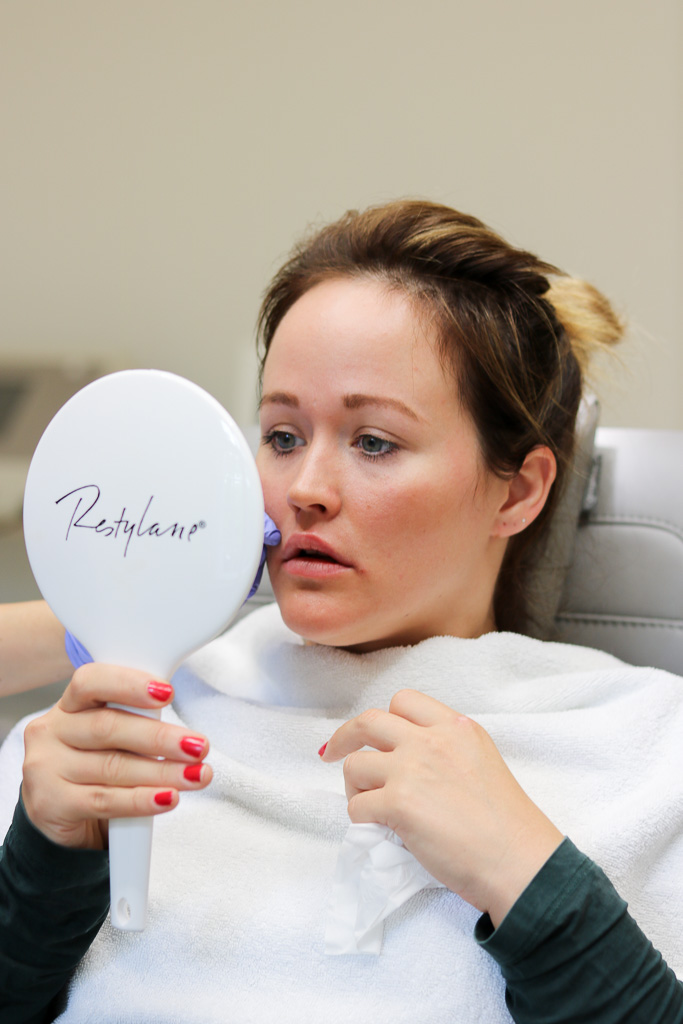 Jen nach der Lippenunterspritzung mit Hyaluronsäure schaut in den Spiegel.