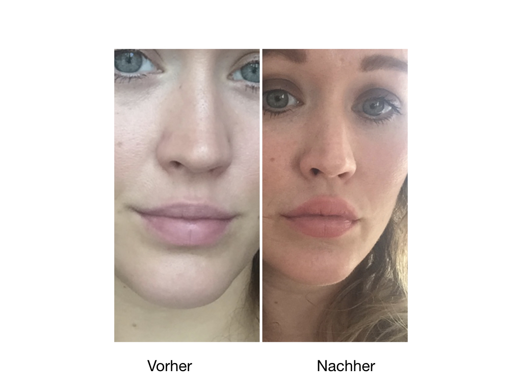 Vorher-NachherBilder einer Lippenunterspritzung mit Hyaluronsäure.