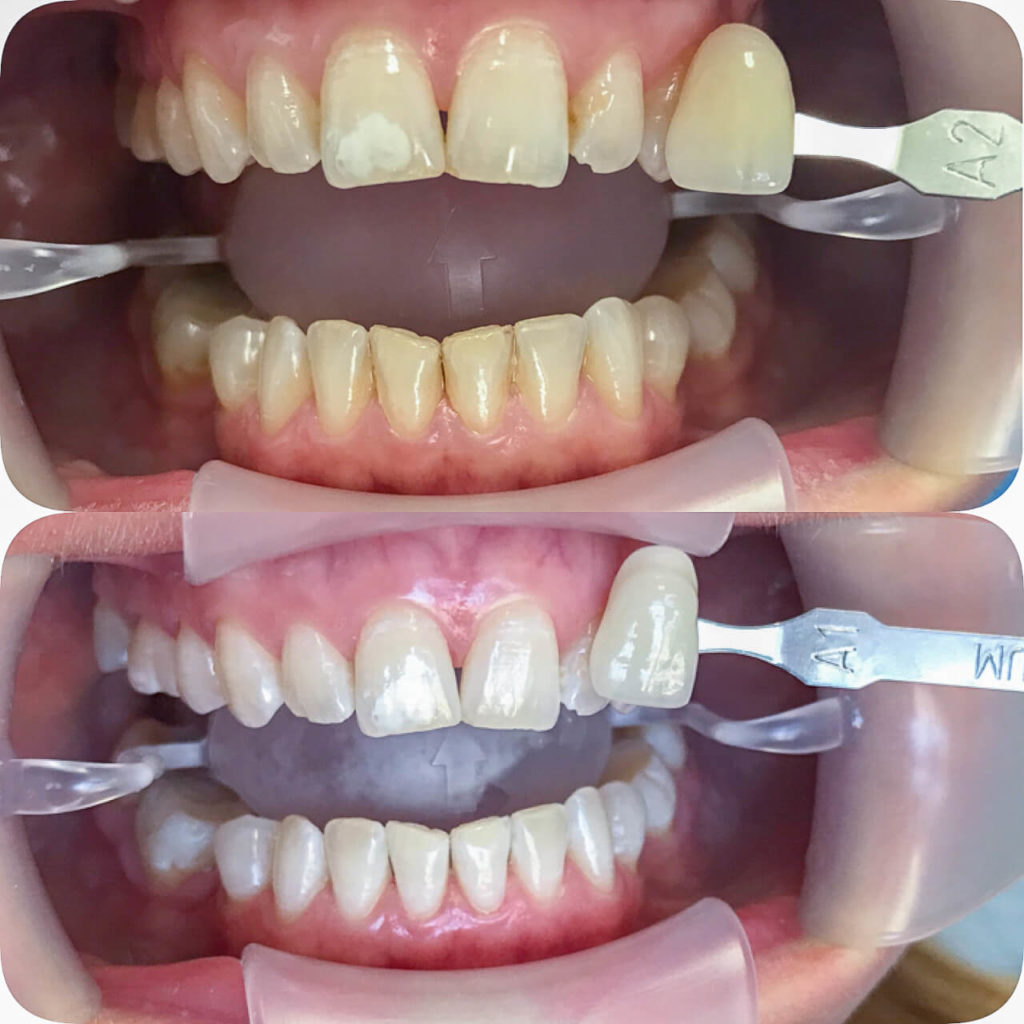 Das Ergebnis vom getesteten Bleaching gegen gelbe Zähne beo ready to smile.