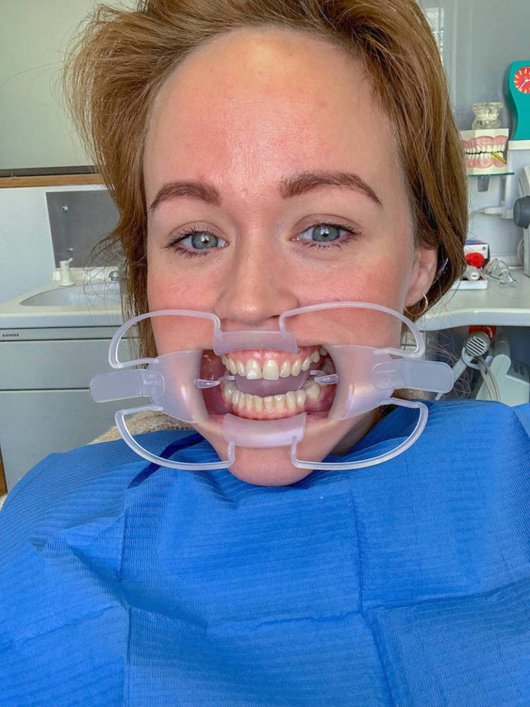 Jen hat die Mundschiene drin für das Zahnblleaching welches sie gleich testet.